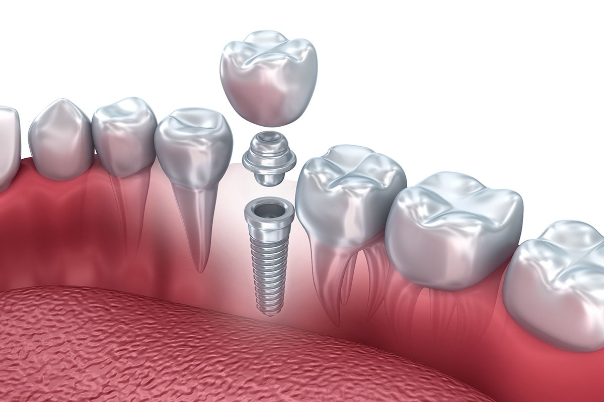 Kemik içi implant şeması — implant vidası, abutment ve kron